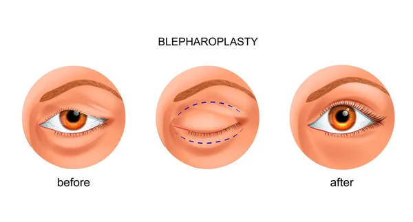 Blepharoplasty of the overhanging eyelid — Stock Vector