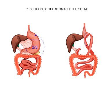scheme of resection of the stomach Billroth 2 clipart