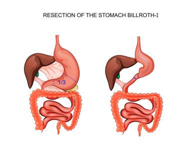 scheme resection of the stomach Billroth 1 clipart