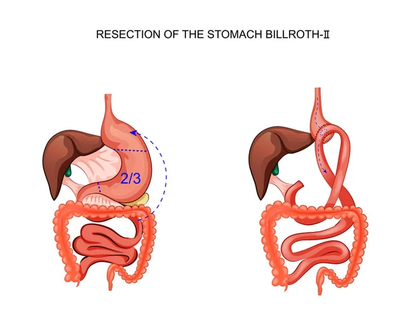 Scheme of resection of the stomach Billroth 2 — Stock Vector