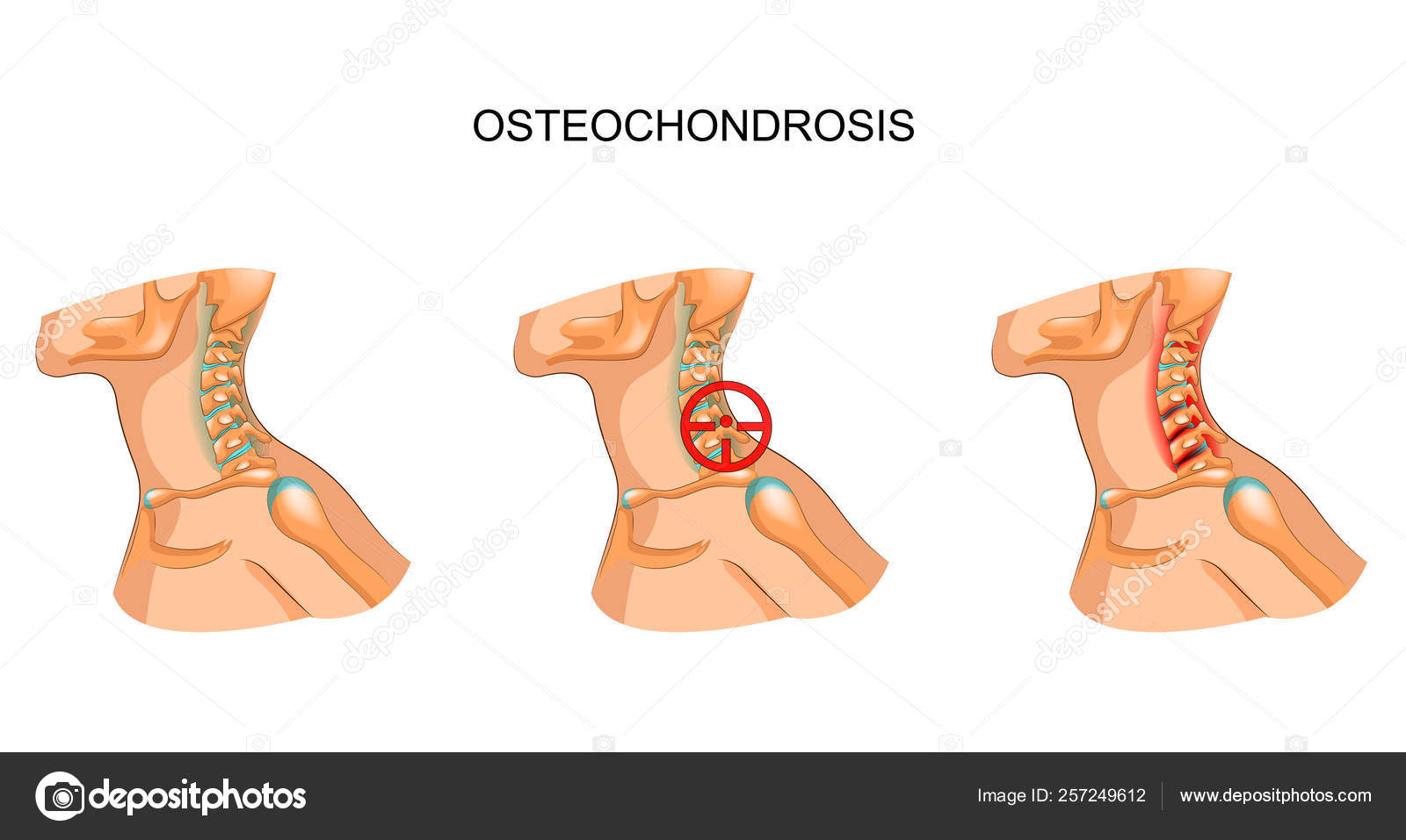 hipertóniás osteochondrosis osteochondrosis kezelése