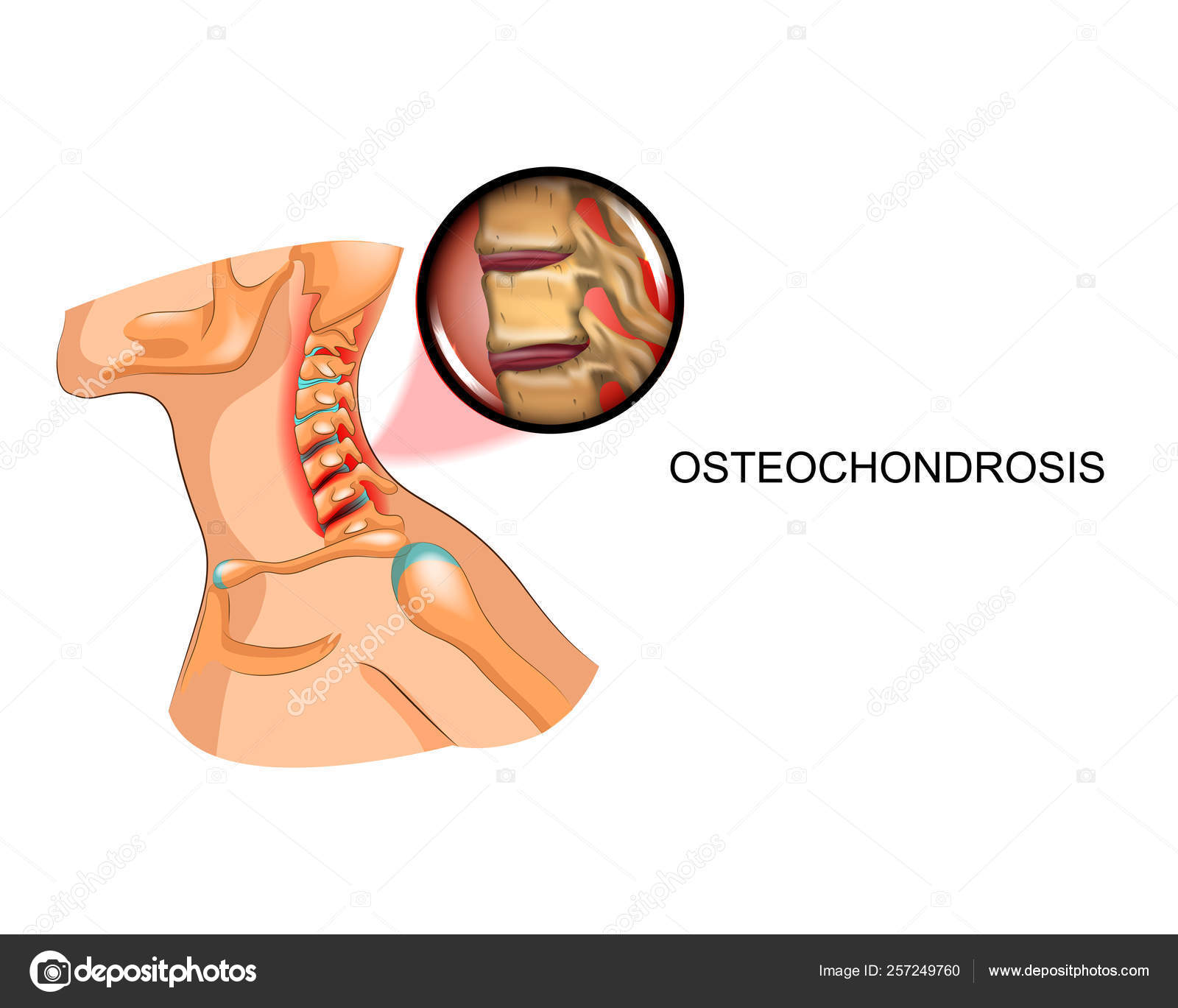 osteochondrosis ár)