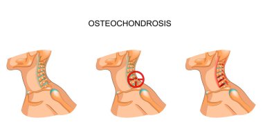 osteochondrosis of the cervical vertebrae clipart
