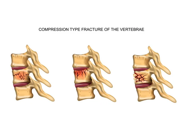 Compression type fracture of the spine — Stock Illustration Compression type fracture of the spine Royalty Free Stock Vectors