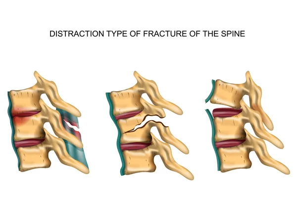 Distraction type de fracture de la colonne vertébrale — Image vectorielle