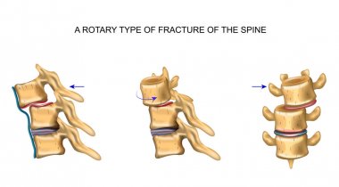 vertebrakırı rotasyonel tipi