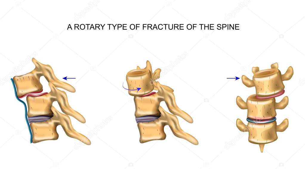 rotational type of vertebral fracture
