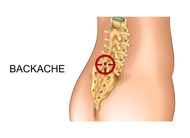 sakrum ve lomber vertebrada ağrı