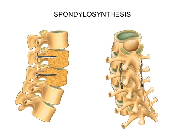 Spondylosynthese. Vertebrale osteosynthese — Stockvector