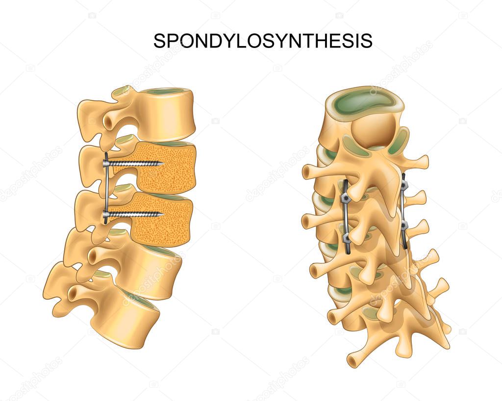 spondylosynthesis. vertebral osteosynthesis