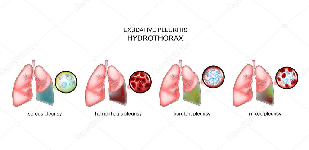 types of exudative pleurisy and hydrothorax