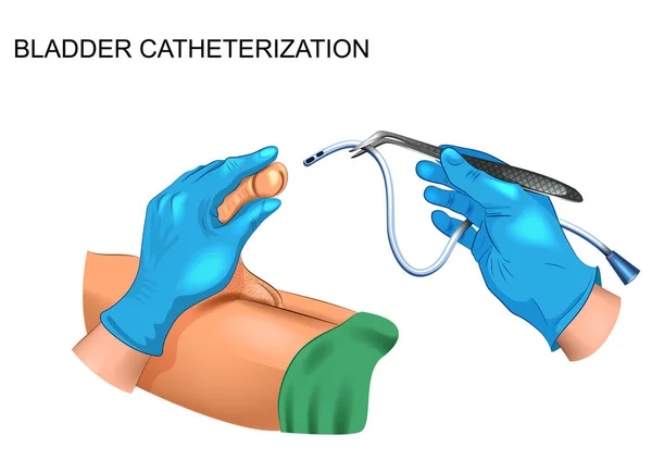 Blaas catheterisatie voor mannen — Stockvector