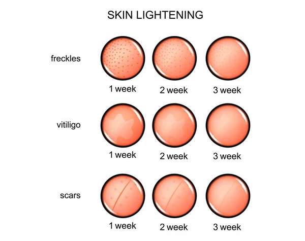 Aufhellung der Haut. Sommersprossen, Vitiligo, Narben — Stockvektor