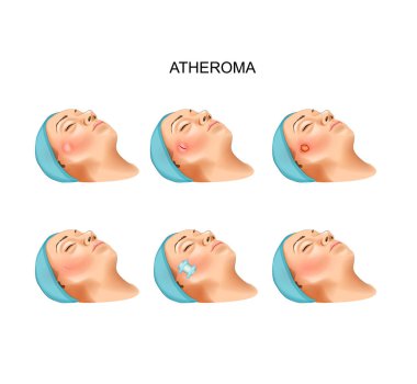 surgery of benign tumors of atheroma clipart