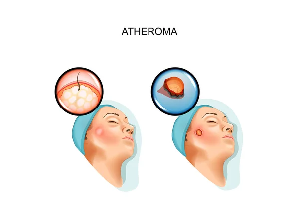 Cirurgia de tumores benignos de ateroma —  Vetores de Stock