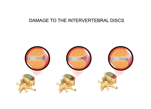 Danni al disco intervertebrale. vertebra — Vettoriale Stock