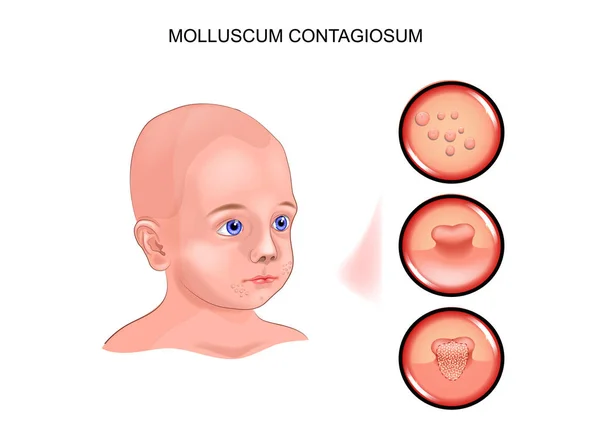 Molluscum contagiosum a gyermek. — Stock Vector