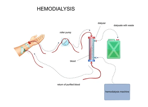 Diagram över hemodialys — Stock vektor