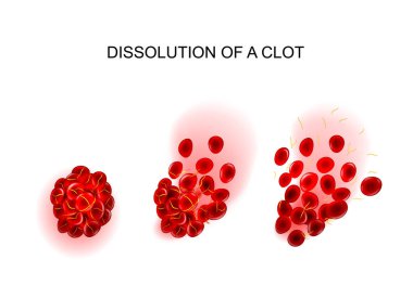 dissolution of the clot. thrombolysis clipart