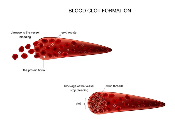 Formación de un coágulo de sangre — Vector de stock