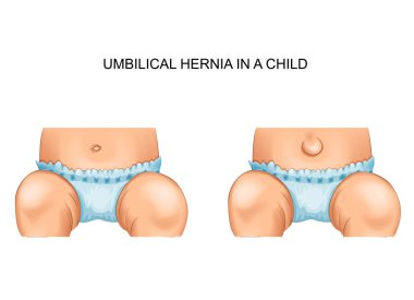bir çocukta göbek fıtığı