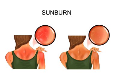 sunburn skin. tan on the girls back clipart