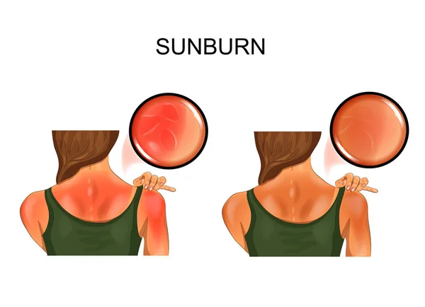 Sonnenbrand Haut. Bräune auf dem Rücken der Mädchen — Stockvektor