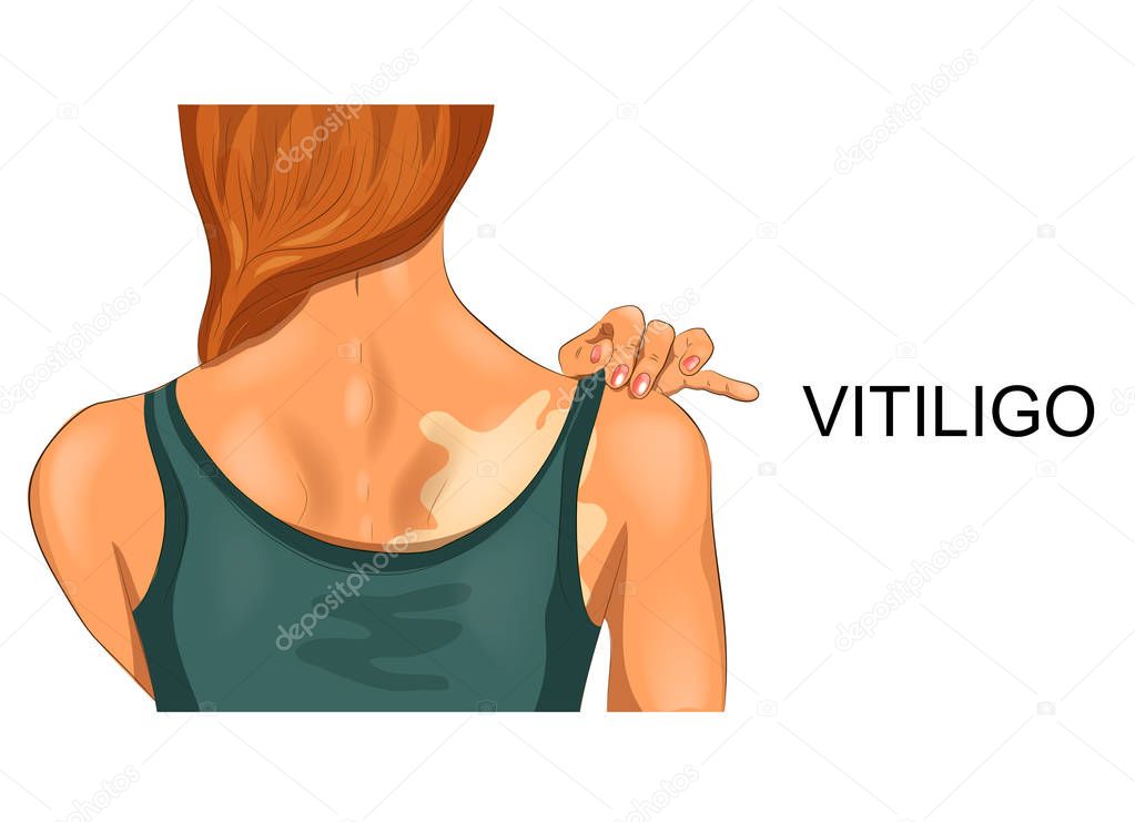 vitiligo on female back