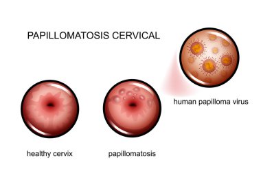 Servikal papillomatozis. Human papilloma virüsü