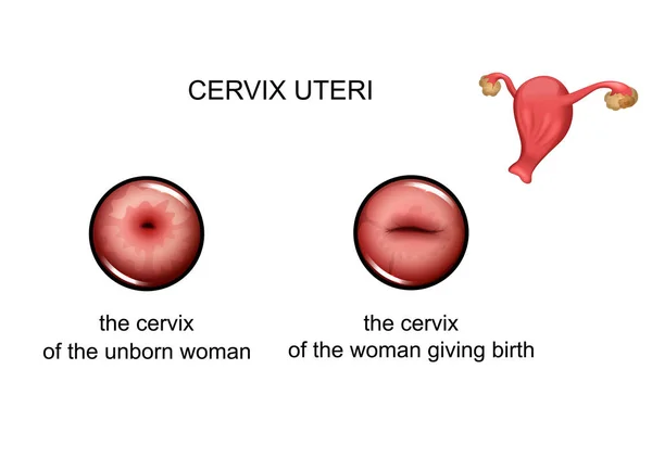Dar à luz e não dar à luz o colo do útero — Vetor de Stock