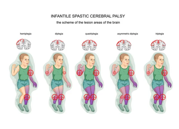 Спастический детский церебральный паралич — стоковый вектор