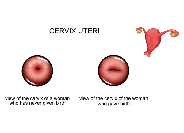 Cuello uterino antes y después del parto — Vector de stock