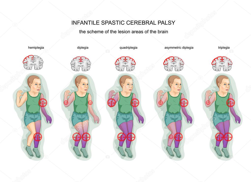 spastic infantile cerebral palsy