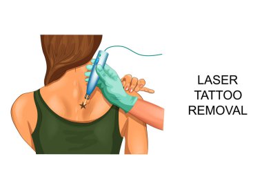 Lazer Dövme Silme