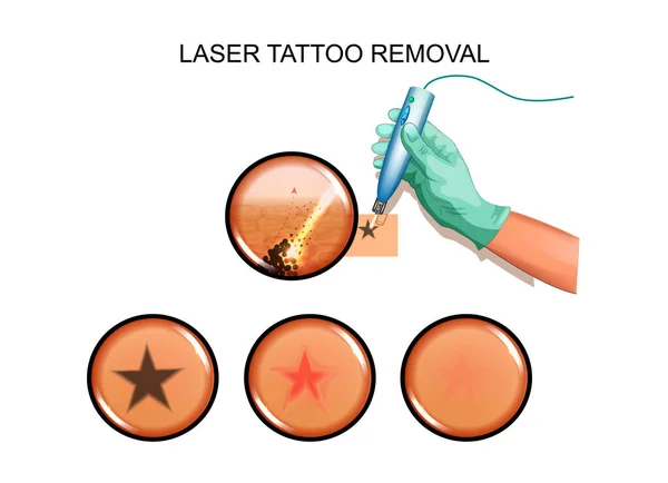 Αφαίρεση τατουάζ με λέιζερ από το δέρμα — Διανυσματικό Αρχείο