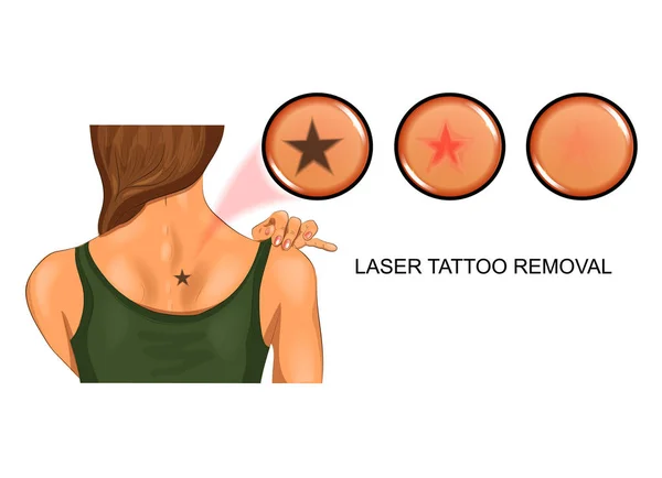 Rimozione del tatuaggio laser dalla pelle — Vettoriale Stock