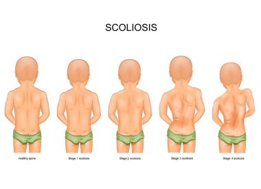 çocuklarda skolyoz