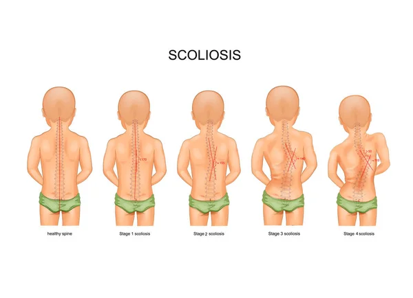 Scoliosis gyermekek — Stock Vector