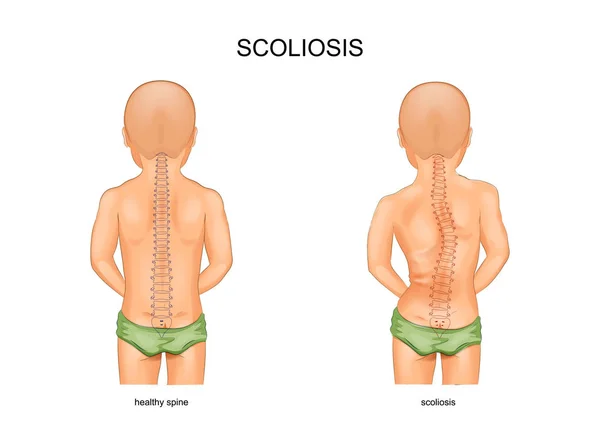 Scoliosis gyermekek — Stock Vector