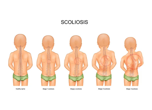 Scoliosis in children — Stock Illustration Scoliosis in children Stock Vector