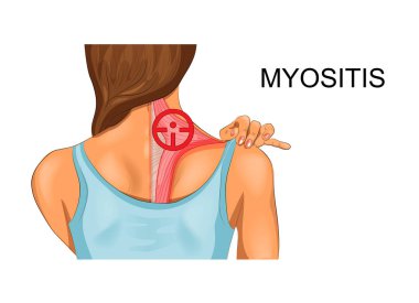 trapezius kas vektör illüstrasyon. miyozit insidansı
