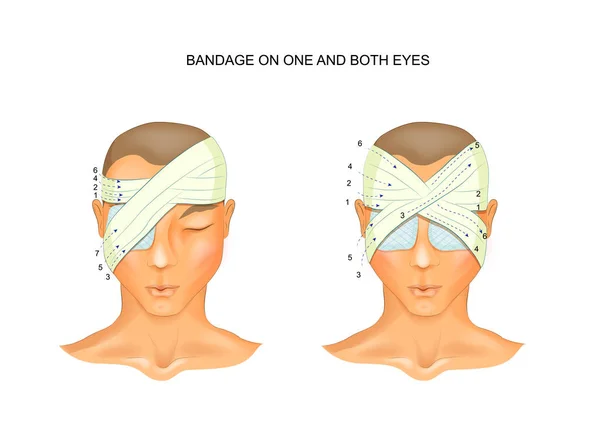 Vendaje en uno y ambos ojos — Vector de stock