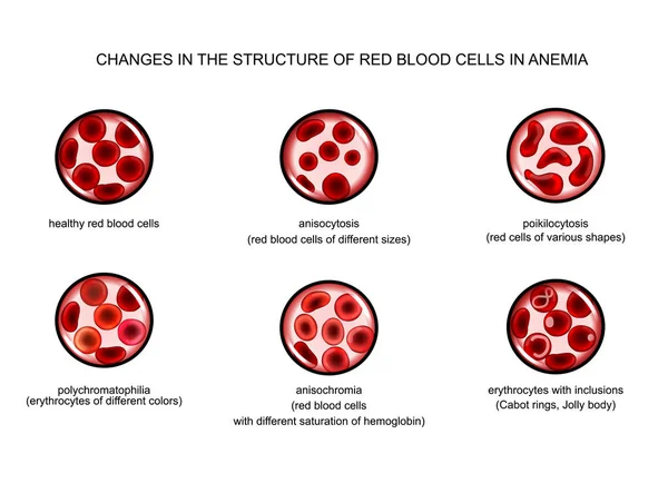 Red blood cells in various anemias — Stock Vector