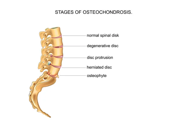 Stages of degenerative disc disease — Stock Vector