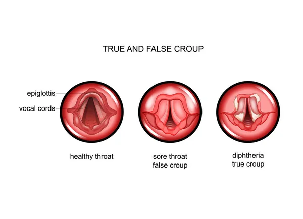 Diphtheria. true and false croup — Stockvector