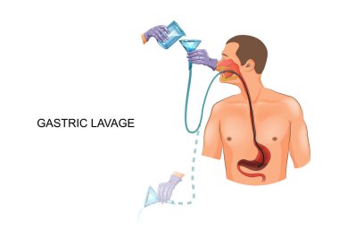 gastric lavage with a gastric tube clipart