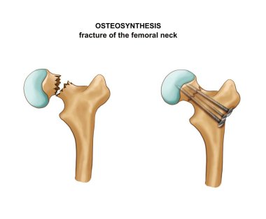Uyluk kemiğindeki kırığın görüntüsü. Osteosentez