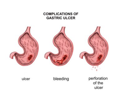 Mide ülseri komplikasyonları. Kanama ve delinme