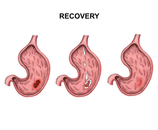 Recovery and healing of stomach ulcers