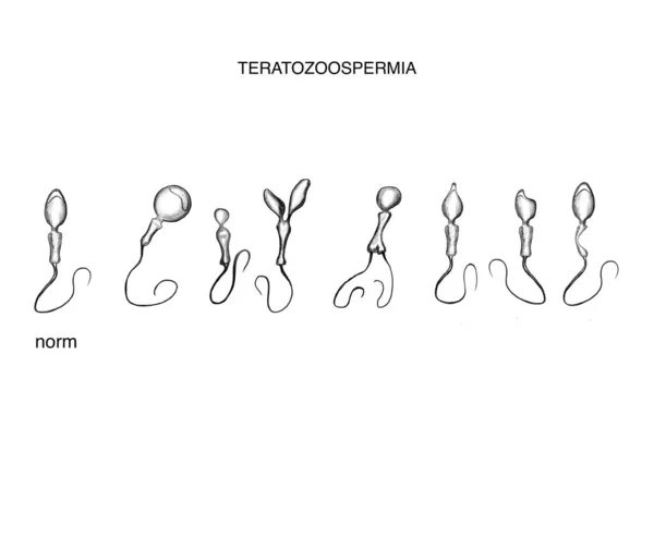 Ілюстрація Дефектної Сперми Тератозооспермія — стокове фото